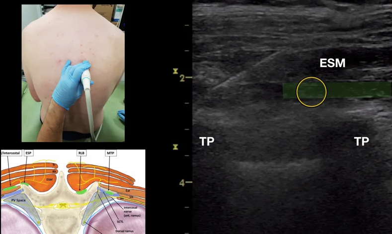 Erector Spinae Plane Block Bc Emergency Medicine Network Bc